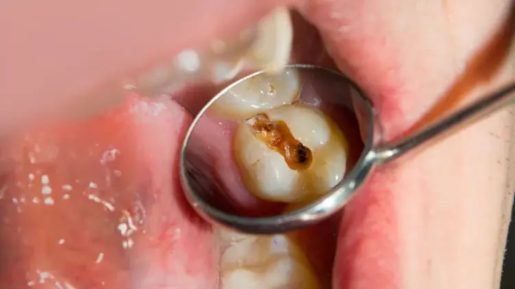 caries-67e71ac468f34